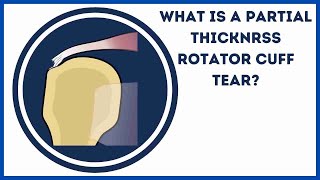 What is a partial thickness rotator cuff tear?