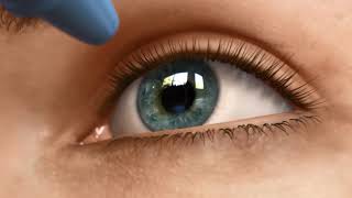 Visian ICL Procedure Overview