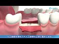 ３D動画で見るデンタルインプラント治療の流れ「インプラントを奥歯に一本埋め入み」
