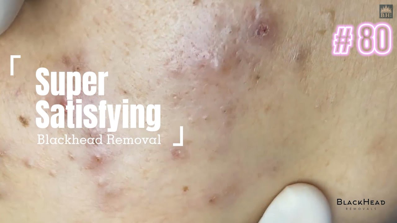 Super Satisfying BLACKHEAD REMOVAL YouTube