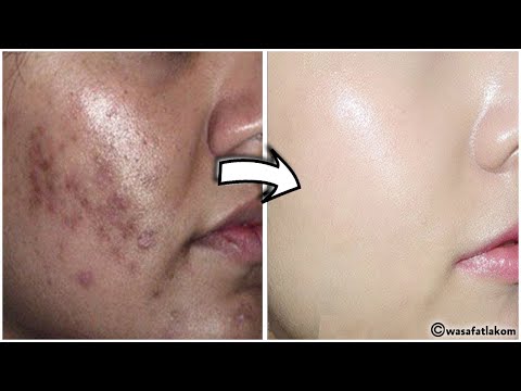 How To Get Rid of Hyperpigmentation - Freckles, Dark Spots, Melasma, Black Patches Fast Naturally