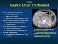 Gastric causes of acute abdominal pain on mdct nonmalignant