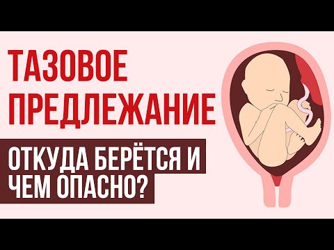 Тазовое предлежание плода: причины, диагностика, способ родоразрешения