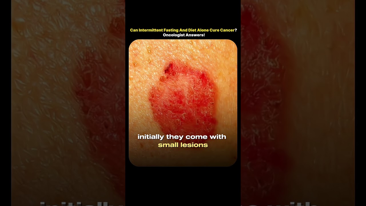 Can Intermittent Fasting And Diet Alone Cure Cancer? Oncologist explains!