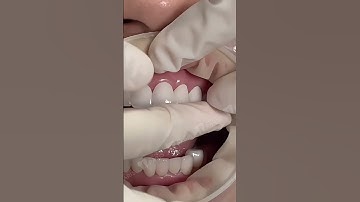 Bọc răng sứ không đau, không mài nhỏ, không trị tủy tại Nha khoa Paris