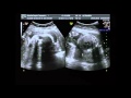 Ultrassom da Amanda (24 semanas e 4 dias) - Morfológico
