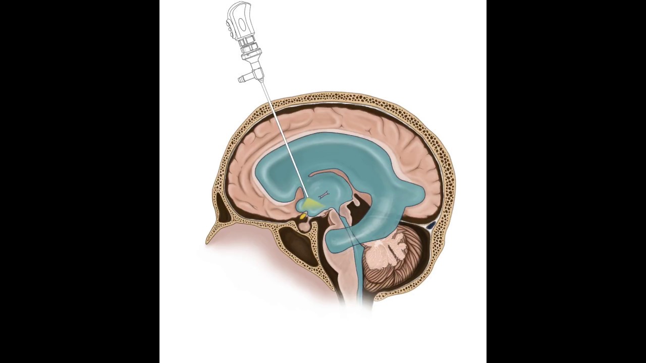 Операция гидроцефалия мозга. Шунт головного мозга при гидроцефалии. Эндоскопическая вентрикулостомия III желудочка. Эндоскопическая вентрикулоцистерностомия. Эндоскопия 3 желудочка головного мозга.