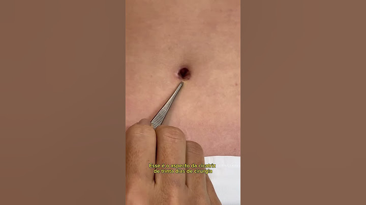 “Dra. Luciana, como fica o umbigo depois da abdominoplastia?”