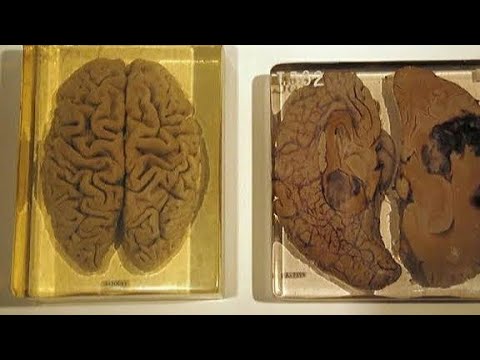 Video: Apa Yang Terjadi Pada Otak Einstein Setelah Kematian Seorang Ilmuwan - Pandangan Alternatif