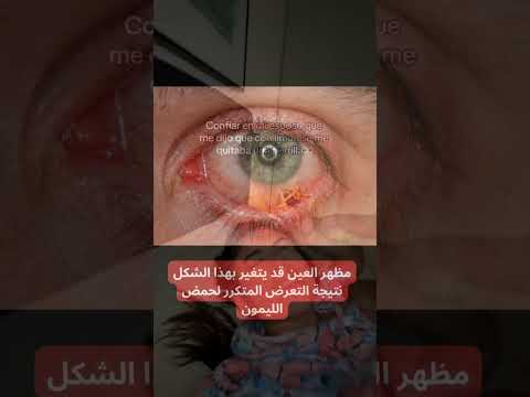 عصير الليمون ذو حموضة عالية يمكن أن تسبب تهيج ا حاد ا للعين العلم ترند اكسبلور عين معلومات