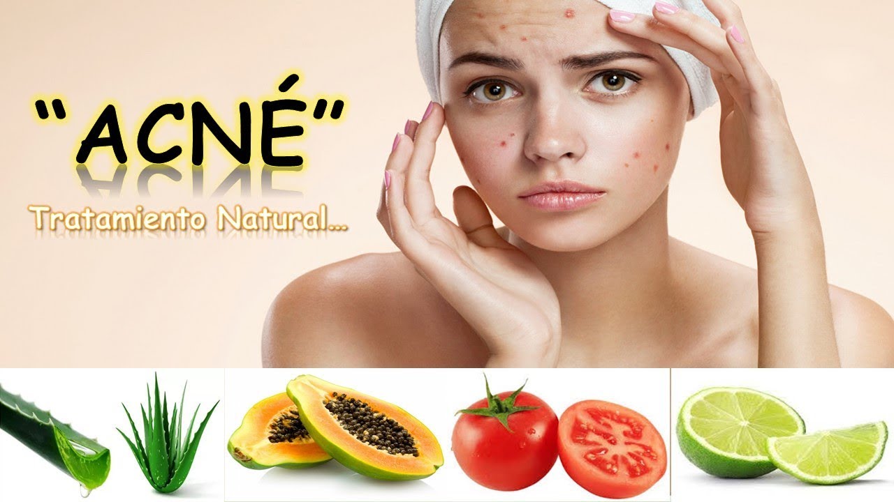 Acne Tratamiento Natural Remedio Casero Nutriciencia Youtube