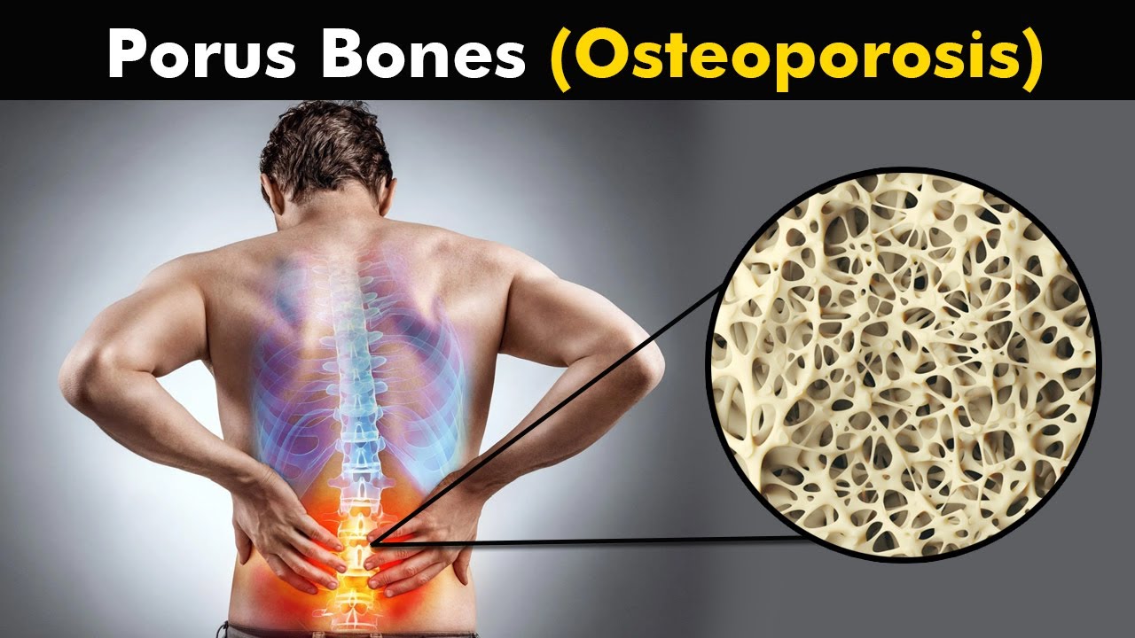 What happens in Osteoporosis | animation | - YouTube