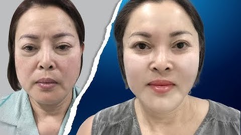 Căng da mặt Mesh Lift không phẫu thuật