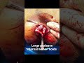 Dx# Large prolapsed internal Hemorrhoids and Thrombsed External hemorrhoids.