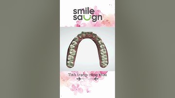 Phác đồ điều chỉnh răng thưa - SmileSalign