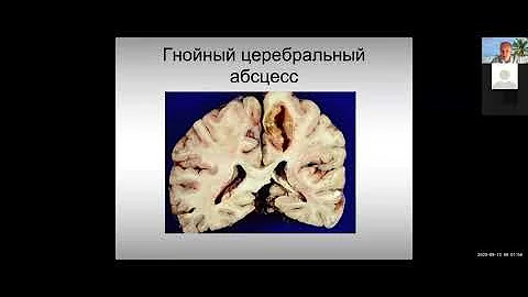 10. Нейроинфекции / Neuroinfection