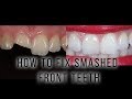 How to fix Smashed Front Teeth