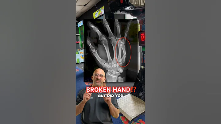 Boxer’s Fracture Complications⁉️ #shorts