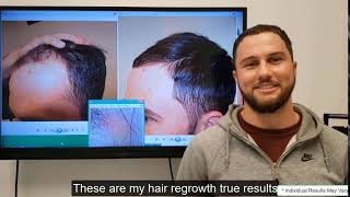 Jonathan regrows his hair with Stop and Regrow