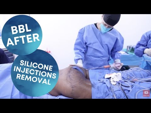 BBL After Silicone Injections Removal
