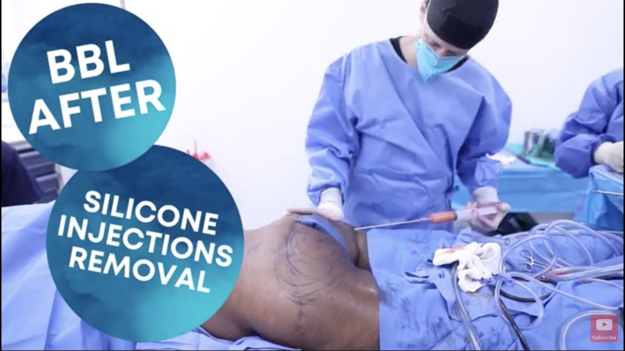 BBL After Silicone Injections Removal - YouTube