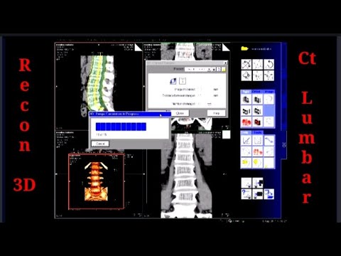 Video: Craniale CT-scan: Doel, Procedure En Voorzorgsmaatregelen