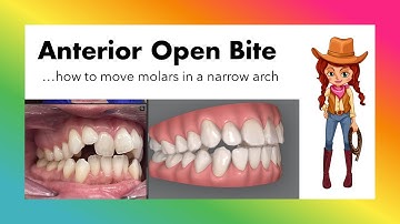 Invisalign ClinCheck - Anterior Open Bite with *predictable* molar movements with 3D controls