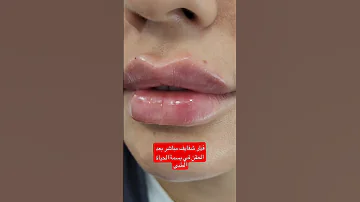 فيلر الشفايف الروسية في مركز بسمة الحياة الطبي 