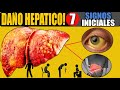 CUIDADO! HIGADO ENFERMO (GRASO) | 7 SIGNOS EXTRAÑOS de DAÑO HEPATICO