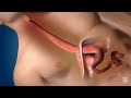 Mayo Clinic Minute: Why early treatment of esophageal cancer is critical