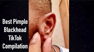 Blackead Com Leaked Videos Download - âœ“ Large Blackheads Removal Best Pimple Popping Videos Download