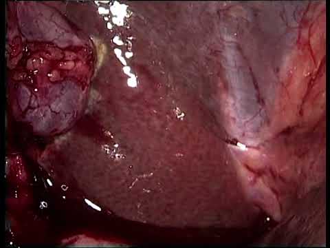 08052015 Laparoscopic cholecystectomy with intraoperative cholangiogram (LC+IOC) part 1