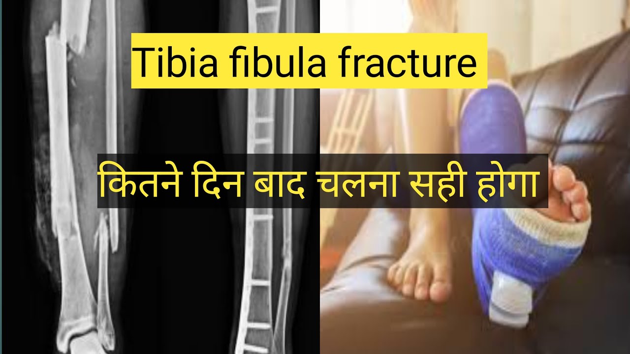 Tibia fibula femur fracture bone fracture fracture recovery time
