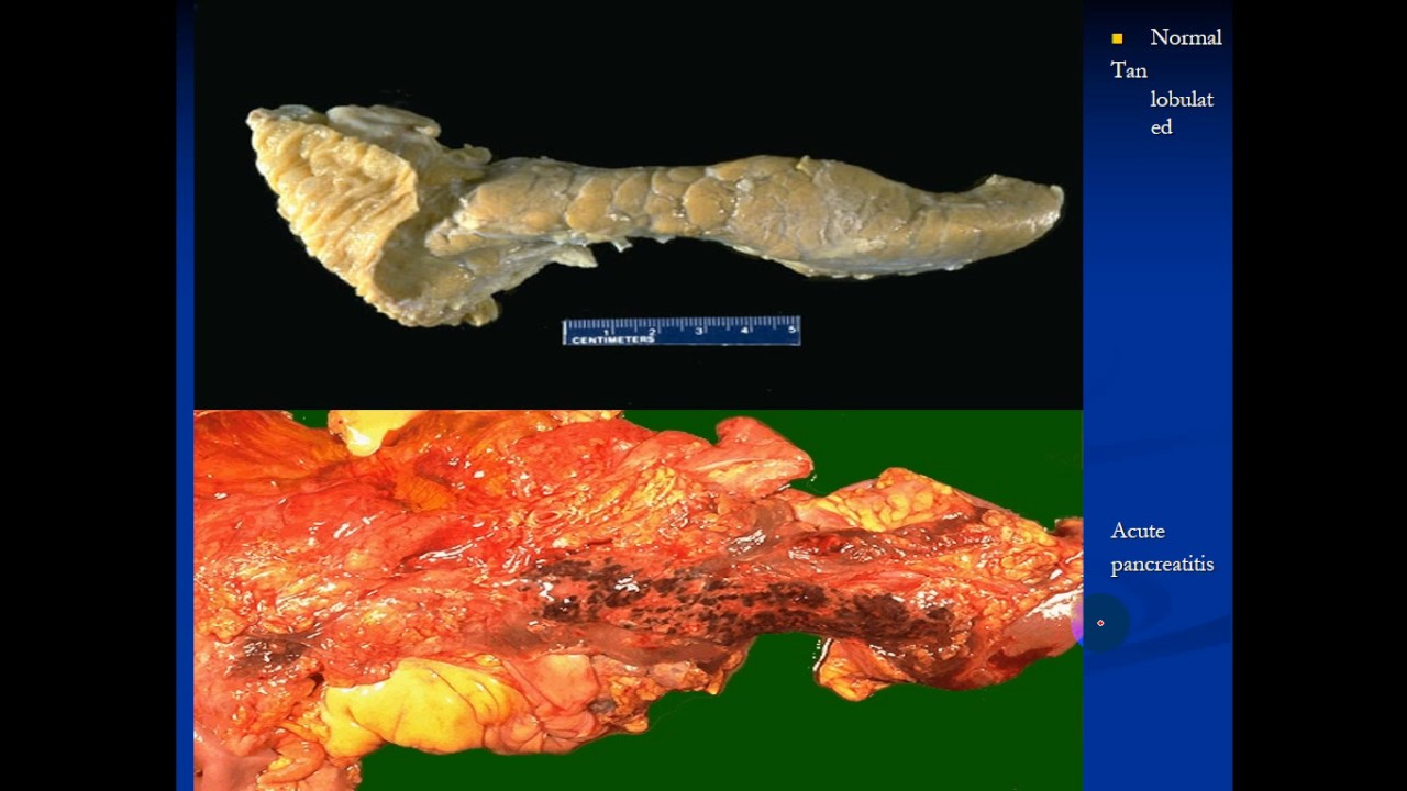 pathology - dr.Dhaymaa -- Pancreas & Gall bladder البنكرياس والمراره