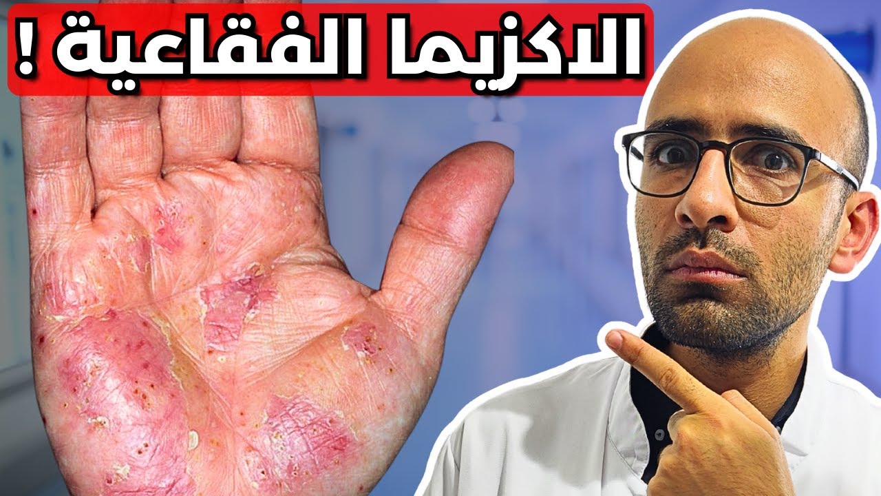 الاكزيما الفقاعية | من اليأس الي العلاج في قصة واقعية !