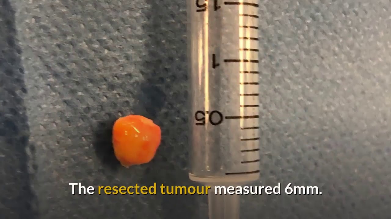 Resection of endobronchial lipoma explained