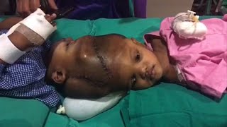 Indian doctors separate twins joined at the head