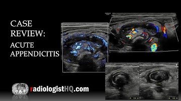 Ultrasound of Acute Appendicitis