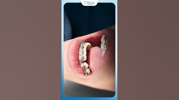 Vì Sao Khi Niềng Răng Bác Sĩ Buộc Thêm Chỉ Thép Ở Hàm Dưới | Nha Khoa Minh Châu