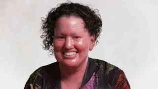 Carly Findlay Abc News Breakfast 31 January 2019