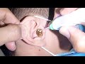 This is one bulky earwax removed from mans ear
