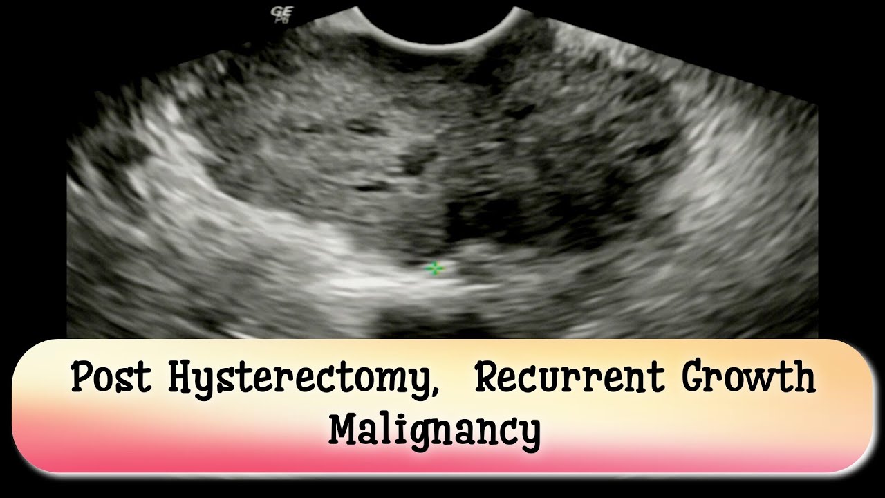 Post Hysterectomy Recurrent Mass Malignancy At Residual Cervical post-hysterectomy-recurrent-mass-malignancy-at-residual-cervical
