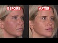 How to sculpt supermodel cheeks for your patients! (It's not JUST about injection technique)