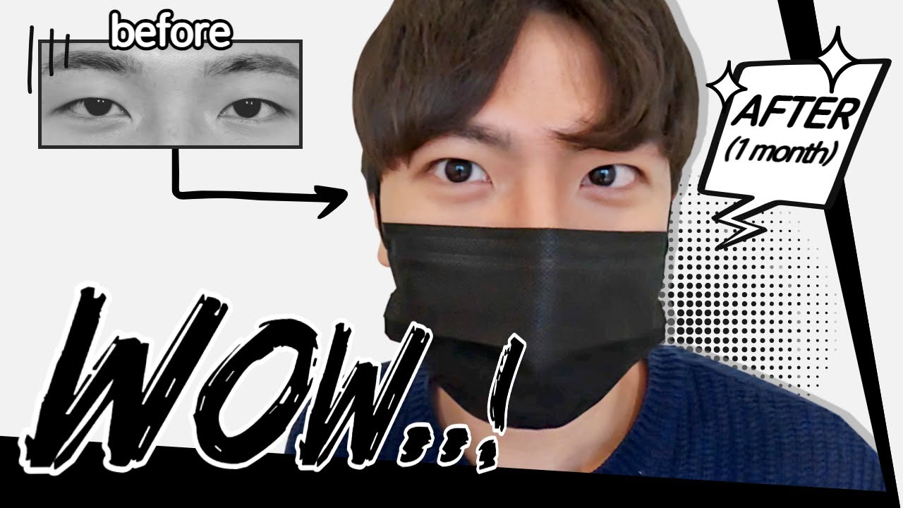 [Вандерфул гоо сайхны мэс заслын эмнэлэг] [EN/JP] Зовхины мэс засал (Нүдний булчингийн засвар)-ын бодит сэтгэгдэл I Эрэгтэй нүдний хэлбэр засах мэс заслын бодит сэтгэгдэл