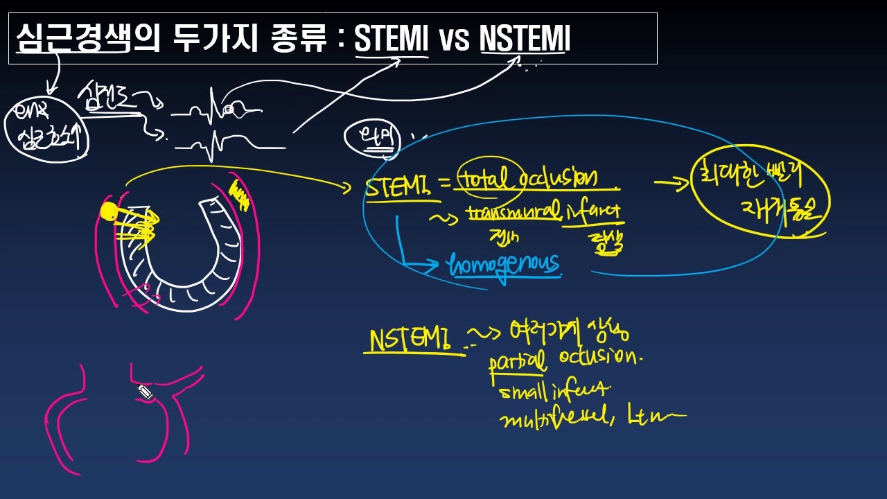 심근경색의 두가지 종류 - STEMI와 NSTEMI
