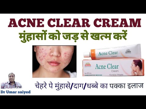 ACNE CLEAR CREAM(मुंहासों को जड़ से  ख़त्म करे)