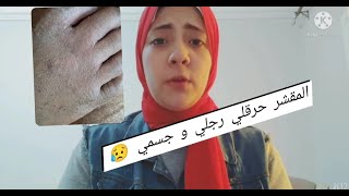 رجلي اتحرقت بسبب مقشر احماض الفواكه تعالي احكيلك حكايتي علشان #متغلطيش_غلطتي