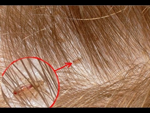 القمل عند الاطفال ما سبب ظهوره اعراض الصيبان وعلاج القمل نهائيا بخطوات مجربة ومذهلة