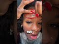 🔥 Why Popping Pimples Feels SO Addictive! 😱💥