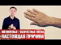 Возрастные пигментные пятна. Как избавиться от печеночных пятен